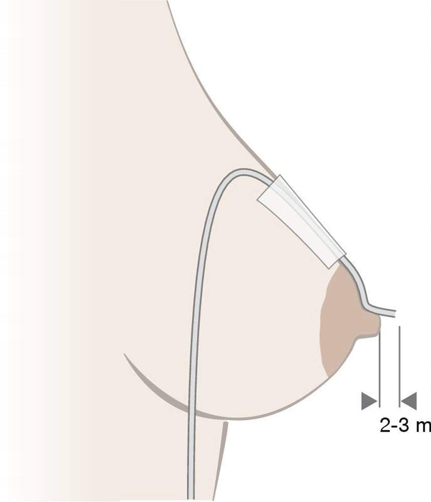 MEDELA system wspomagający karmienie piersią (SNS) – ilustracja użycia cienkiej rurki przy piersi matki